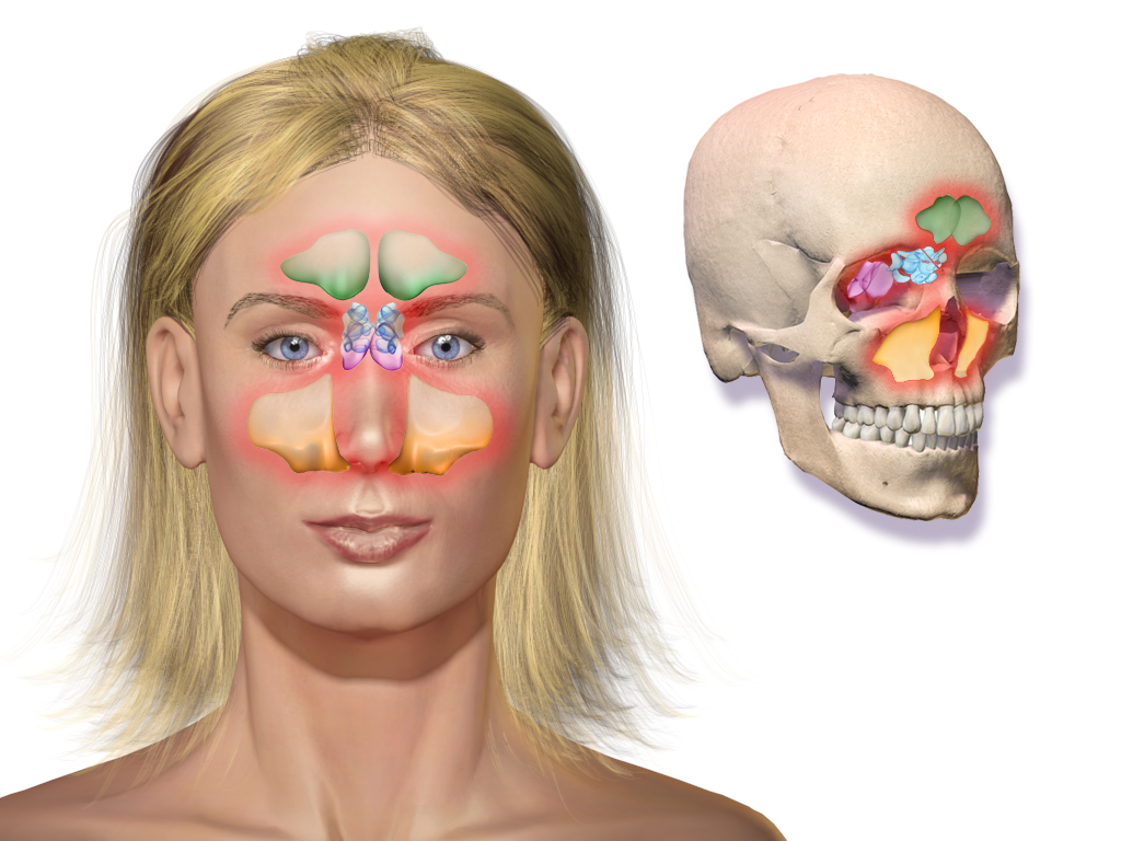 Anatomical illustration of the four sinus groups in a frontal face and a skull section; red shading depicts inflammation
